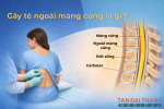 Gây tê ngoài màng cứng là gì