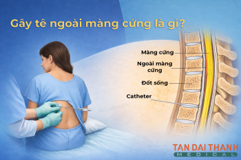 Gây tê ngoài màng cứng là gì