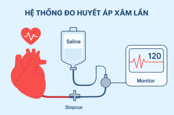 IBP là gì? Những điều cần biết khi theo dõi huyết áp bằng phương pháp xâm lấn
